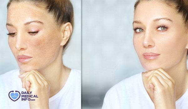 أهم 13 طريقة مستخدمة في علاج تصبغات الوجه